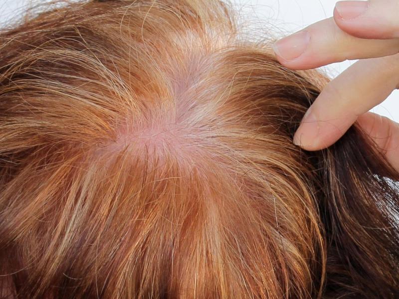 Medicine To Stop Hair Growth On Face