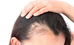 The Influence of Genetics on Women’s Hair Loss